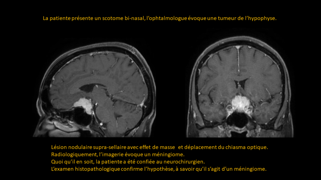 Réponse Méningiome