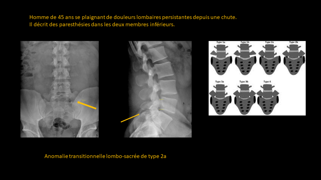 Réponse lombaire