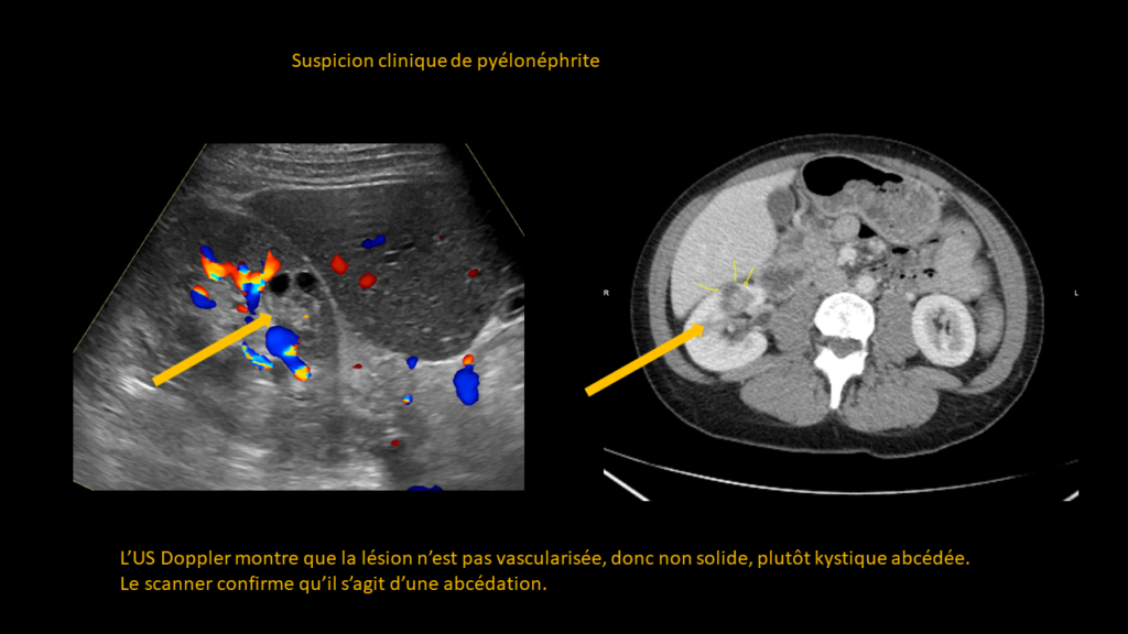 Réponse pyélonéphrite