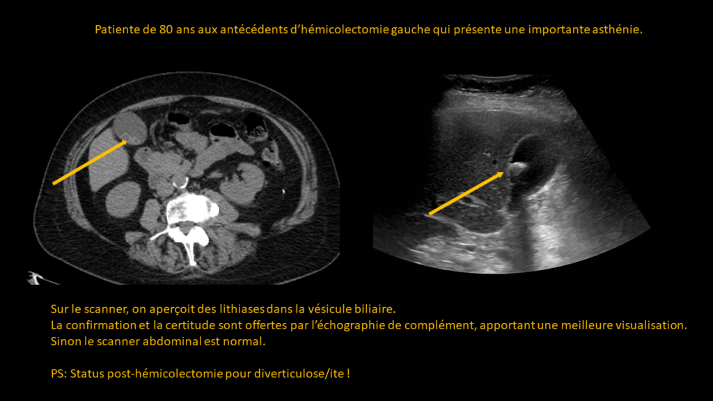 Réponse abdomen