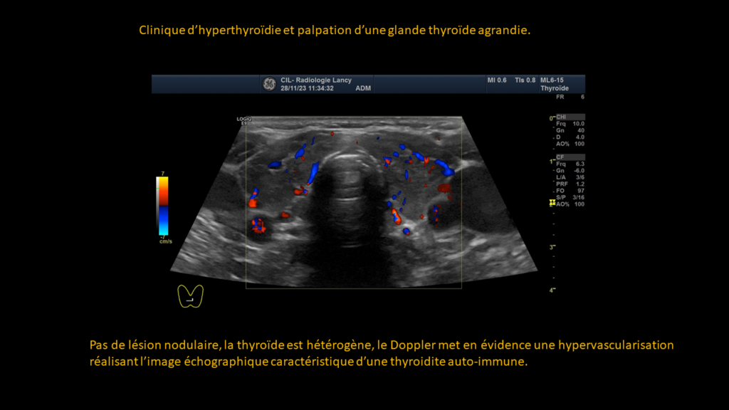 Réponse thyroide