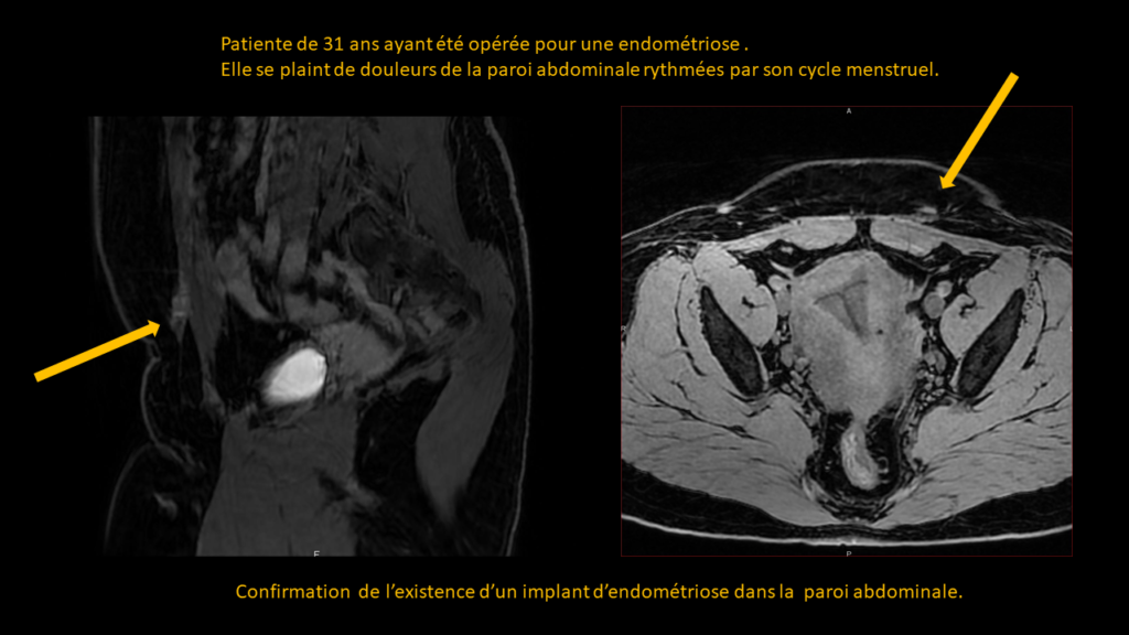 Réponse endométriose