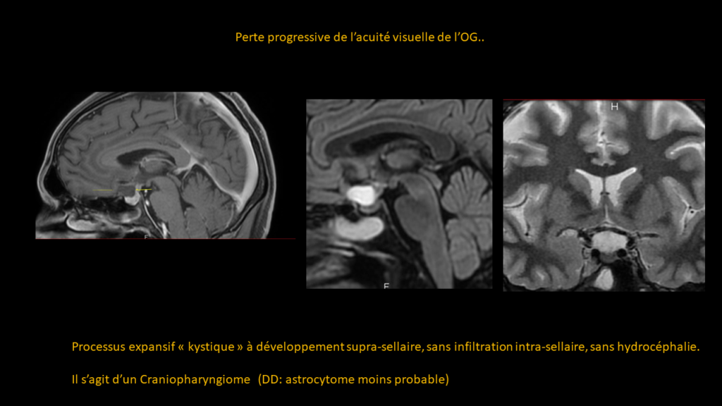 Réponse cranyopharyngiome