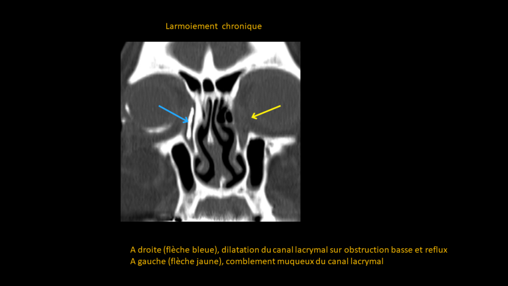 Réponse nasal