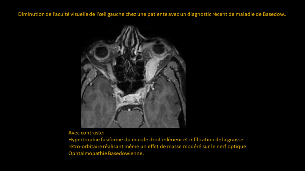 Réponse Basedow