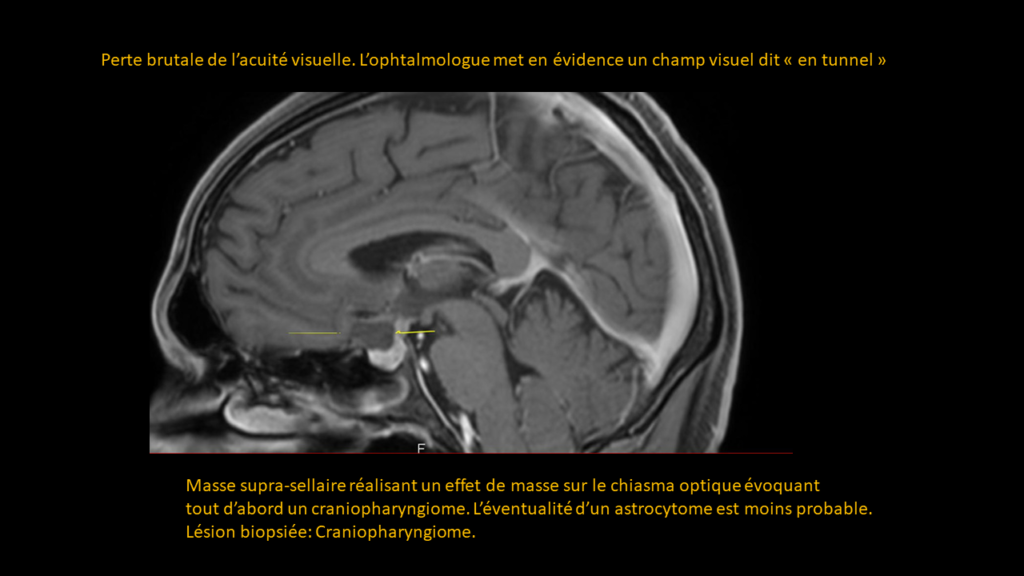 Réponse Cranyopharyngiome