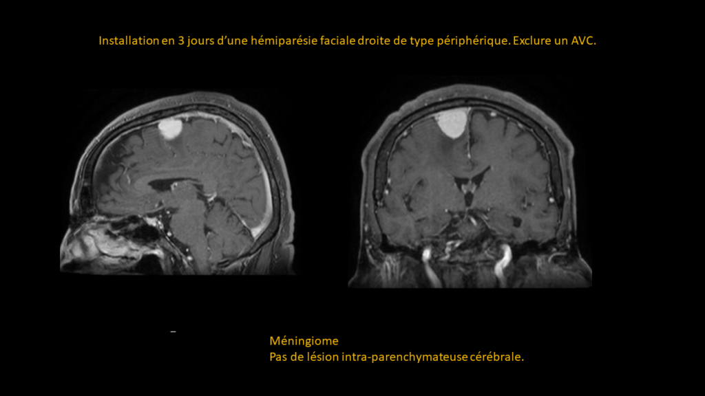 Réponse Méningiome